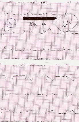 ekg